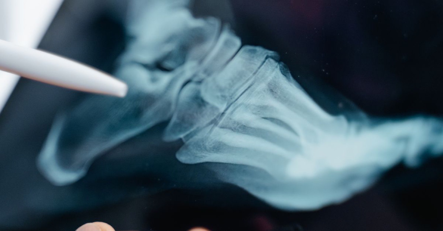 Ultrazvučni aparat za osteodenzitometriju u Nela Medica centru